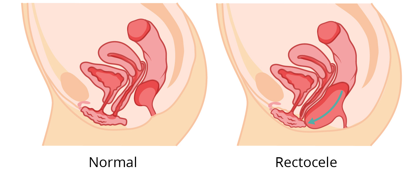 Illustration showing a rectocele.