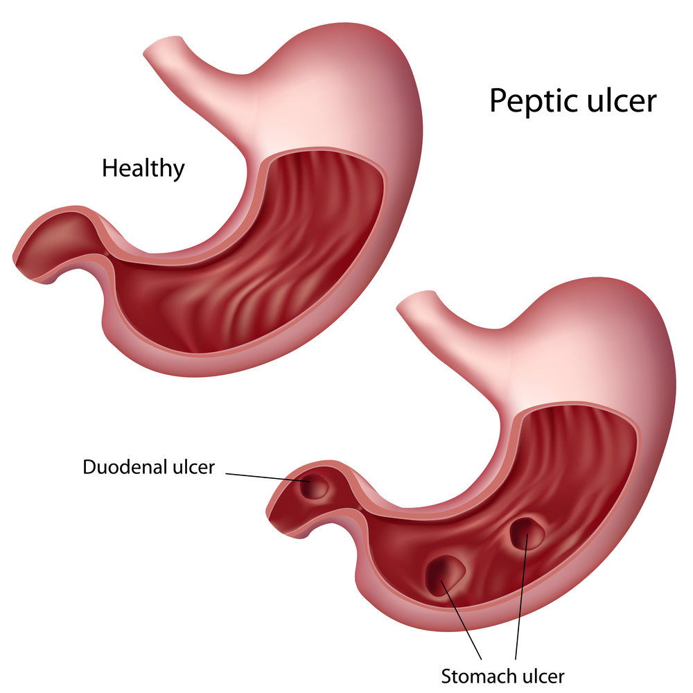 An illustration of a normal stomach next to one that has 2 duodenal ulcers in the inner lining.