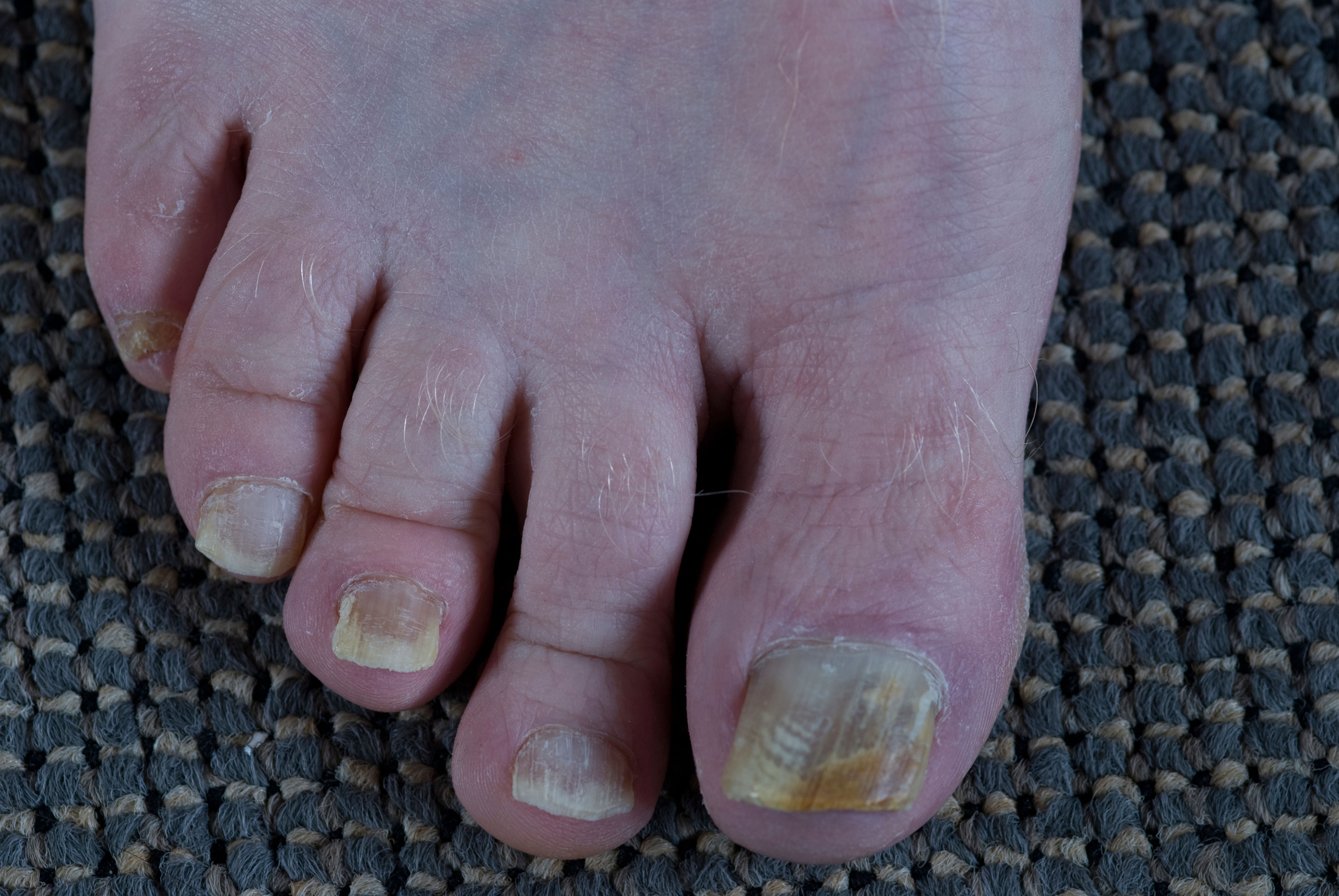 An image showing a foot with a noticeable fungal infection on the large toenail. The toenail appears yellow and thickened, indicating the presence of the infection.