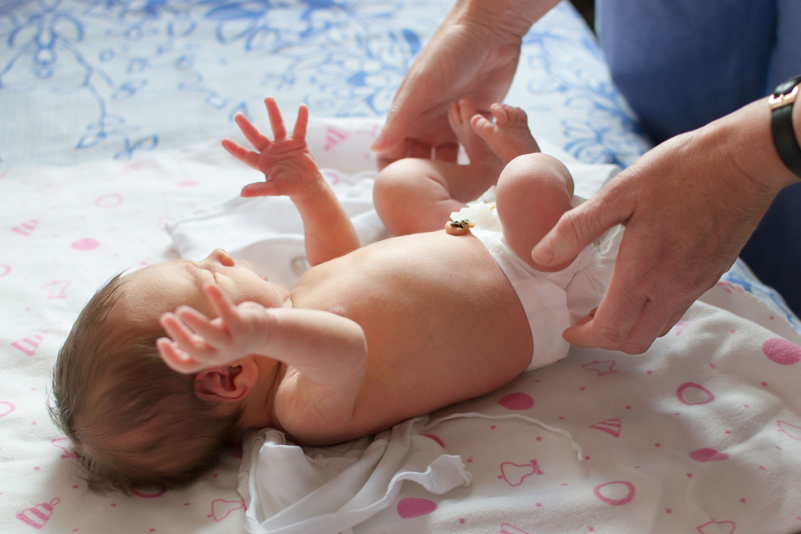 Image of a new born baby with umbilical stump still attached.