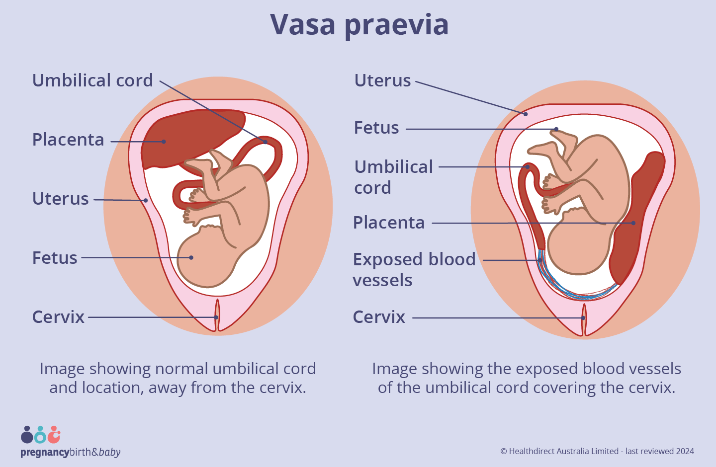 Illustration of normal umbilical cord position (left) and vasa praevia (right) during pregnancy.